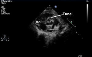 Eje paraesternal corto en 2D: válvula aorta trivalva (Ao) con imagen del túnel en seno coronariano derecho.