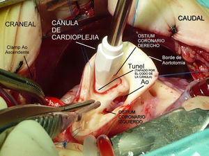 Vista quirúrgica del túnel en el extremo aórtico: Válvula aórtica con imagen del túnel inmediatamente superior a la válvula.