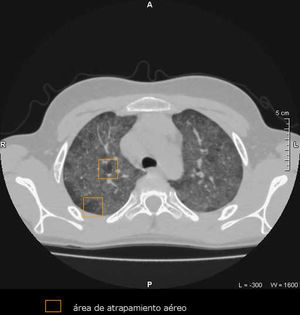 Corte espiratorio de tomografía computarizada torácica de alta resolución que muestra áreas parcheadas de atrapamiento aéreo.