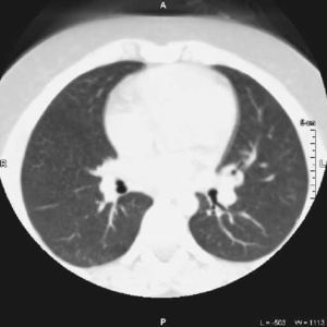 Tomografía computarizada realizada a los 3 meses del tratamiento con resolución de las imágenes descritas.