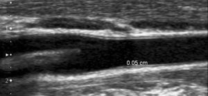Imagen de ultrasonido de un corte longitudinal de la pared posterior de la carótida, en la que se muestra el grosor íntima-media.