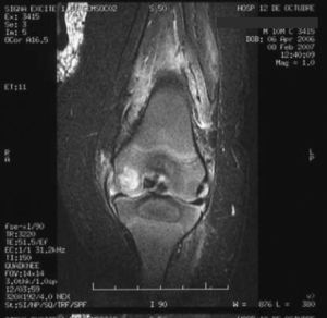 Resonancia magnética inicial de rodilla izquierda. Derrame articular en cantidad moderada y marcado engrosamiento sinovial. Alteración de la intensidad de señal del cartílago del cóndilo femoral interno izquierdo, que contacta con la superficie articular. Compatible con artritis con afectación femoral.