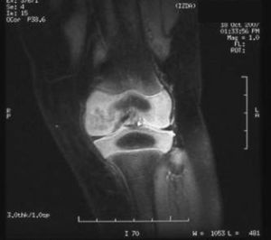 Resonancia magnética de rodilla izquierda al finalizar el tratamiento antifúngico. Alteración en la intensidad de señal del cartílago epifisario del cóndilo femoral interno, en relación con secuelas de osteomielitis y artritis conocidas, sin edema ni derrame articular. Evolución favorable de artritis.