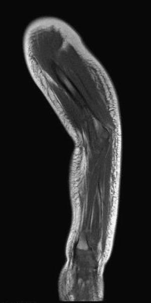 Resonancia magnética: colección subcutánea en íntima relación con la fascia muscular en el dorso del antebrazo, con hipercaptación de ésta.