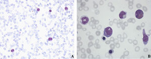 A) Extensión de sangre periférica que muestra displasia en serie eritroide y monocitosis discreta (10%) con el 1% de blastos en serie blanca. B) Aspirado de médula ósea, en el que el 10% corresponde a la serie eritroblástica con rasgos displásicos leves como punteado basófilo; el 41% corresponde a la serie granulopoyética con desgranulación y cuerpos de Dölhe; el 41% corresponde a la serie linfoide, con linfocitos de aspecto maduro; el 3,2% corresponde a la serie monocítica, y el 4,6% corresponde a la serie de blastos; los macrófagos son escasos, de aspecto normal y con ausencia de parásitos.