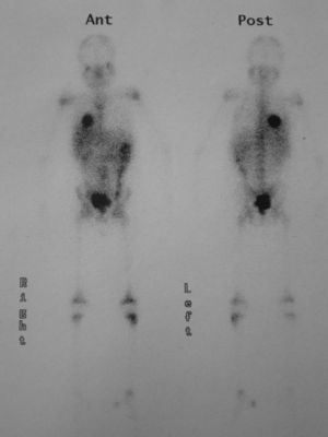 Gammagrafía con galio: captación del marcador en las áreas distal y proximal de la tibia izquierda y en la base pulmonar derecha.