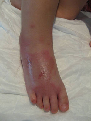 Celulitis en el pie, previamente al inicio del tratamiento corticoideo.