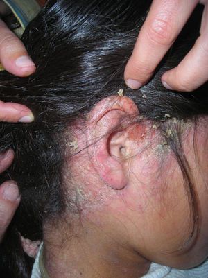 Placa eritematosa y descamativa en la zona retroauricular y el cuero cabelludo.