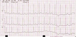 Electrocardiograma basal. En precordiales izquierdas se observa espacio PR corto y empastamiento de la rama ascendente de complejo QRS (onda δ), ambos hallazgos compatibles con el síndrome de Wolf-Parkinson-White.