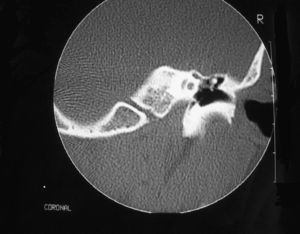 Tomografía computarizada de peñascos del oído derecho, ocupación colesteomatosa en el ático del oído sin otra afectación.