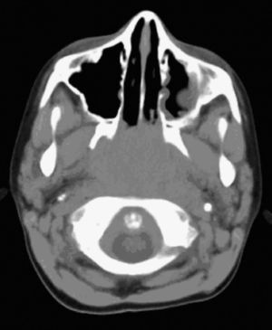 Masa de densidad de partes blandas que ocupa rinofaringe. Los cambios en los senos son secundarios a la epistaxis.