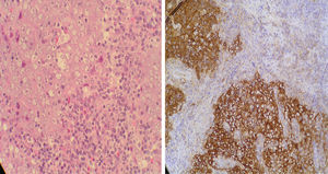 Microscopia óptica de carcinoma nasofaríngeo indiferenciado. Tinción hematoxilina-eosina. Infiltrado linfoide grave entremezclado con grupos celulares que forman nidos epiteliales tumorales. Análisis inmunohistoquímico: positivo para citoqueratina confirmando la estirpe linfoepitelial del tumor.