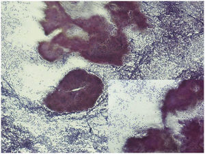 Punción aspirativa con aguja fina de tumoración laterocervical izquierda, en la que se observa infiltrado inflamatorio agudo con colonias de gérmenes filamentosos compatibles con actinomicosis cervicofacial.