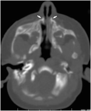 Corte de tomografía computarizada en plano transversal, centrada en los procesos nasales del maxilar, que muestra disminución de la distancia entre ellos (flechas) que provocan estenosis del orificio piriforme.