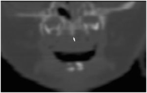 Reconstrucción de la tomografía computarizada en plano coronal en la que se observa la presencia de la cresta central del paladar duro (flecha).