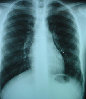 Radiografía de tórax tras embolización de la fístula con 4 plugs vasculares.