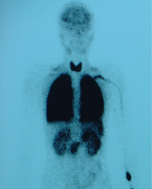 Gamagrafía pulmonar de perfusión. Actividad de radiotrazador en cerebro, tiroides, bazo y riñones. Cortocircuito de derecha a izquierda del 28%.