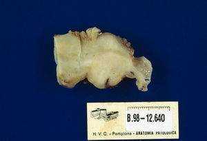 Se observa una lesión de aspecto polipoideo de unos 6cm de diámetro, con coloración pardoviolácea, recubierta de mucosa normal y con cierta ulceración en su superficie.