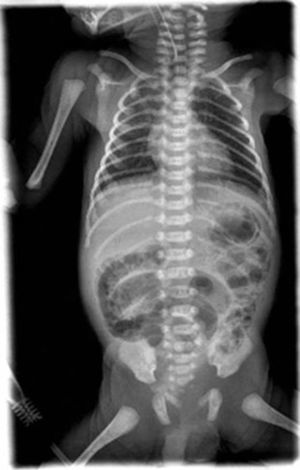 Radiología simple de abdomen con pneumatosis gástrica e intestinal.