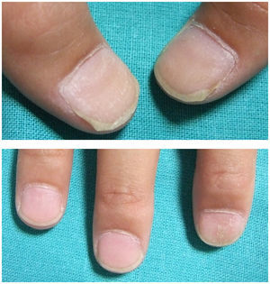 Aspecto clínico de las uñas tras 6 meses con tratamiento con apósitos ungueales con importante mejoría de las lesiones.