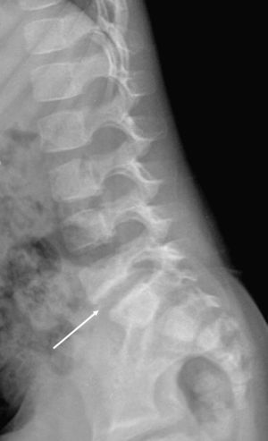 Radiografía lateral de columna lumbar en seguimiento a los 3 meses. En el control se observa la deformación con lisis de los platillos vertebrales así como su esclerosis (flecha).