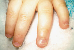 Aspecto de las uñas en un paciente 6 semanas después de la enfermedad boca-mano-pie.