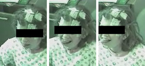 Niña de 9 años con narcolepsia-cataplejia. Protusión de la lengua característica de los episodios de cataplejia en niños, facies catapléjica (imágenes obtenidas del registro de vídeo).