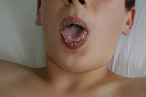 Mucositis grave: lesiones seudomembranosas orales.