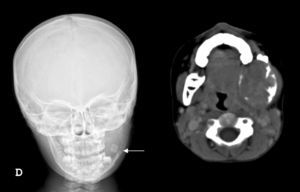 Imagen transparente con apariencia de «diente flotante» en la radiografía simple. Imagen lítica, expansiva con preservación de la cortical mandibular y ausencia de captación de contraste en la tomografía computarizada.