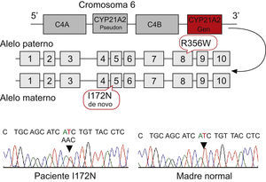 Esquema del gen CYP21A2, donde se señala la localización de las mutaciones identificadas. Estudios de secuenciación en el afectado y en la madre que confirman la mutación de novo I172N en el caso índice, ausente en el ADN materno.