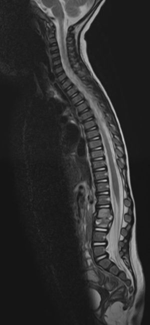 RM de columna completa. El disco intervetebral L2-L3 presenta una marcada alteración de la señal y desestructuración del mismo. Existe un componente de partes blandas posterior que protruye hacia el interior del canal raquídeo, improntando el margen anterior del saco tecal. Discreta rectificación de la cifosis dorsal.