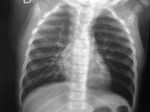 Radiografía PA del tórax: cuerpo extraño radiopaco en BPI.