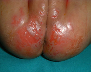 Dermatitis erosiva de las nalgas con placas exfoliativas.