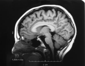 Resonancia magnética nuclear cerebral: leve atrofia difusa en protuberancia, imagen hiperintensa en FLAIR y T2 en región periacueductal.