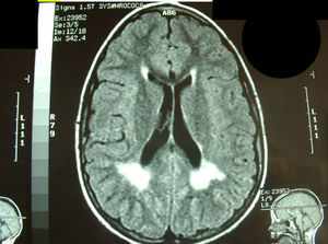 RM secuencia FLAIR, corte axial. Hiperintensidad bilateral de sustancia blanca periventricular posterior.