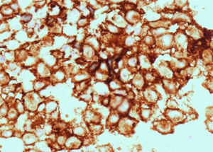 Inmunotinción de las células lesionales con el anticuerpo CD1a (400x).