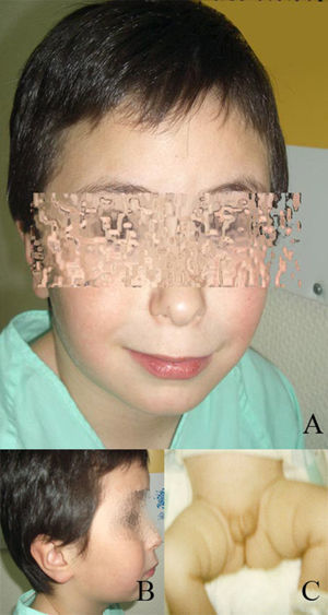 A) y B) Dismorfias faciales: hipertelorismo, hipoplasia malar, epicantus, labio superior fino, implantación auricular baja. C) Hipospadias interescrotal con palpación de ambas gónadas en labios escrotales. Pene hipoplásico. Estadio III de Prader.