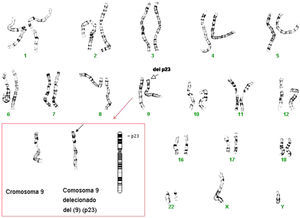 Cariotipo con 46 cromosomas, fórmula sexual XY. Técnica de citogenética que muestra una deleción del telómero de brazo corto del cromosoma 9. Técnicas de bandas G determina deleción terminal de las bandas (p23-pter) de un cromosoma del par 9.