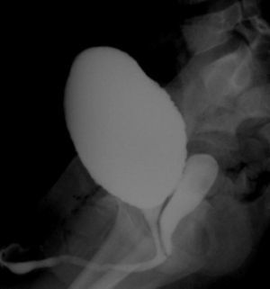 Cistografía en la que se observa una cavidad compatible con vagina que desemboca en uretra.