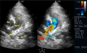 Ecocardiografía (paraesternal eje corto): el tronco pulmonar (TP) se continúa con la rama pulmonar derecha (RPD) y de esta nace la rama pulmonar izquierda (RPI) que rodea a la tráquea (T) por detrás, creando el sling. Aorta (Ao).