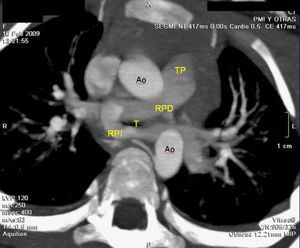 TC: imagen tomográfica equivalente de la ecocardiográfica. Tronco pulmonar (TP), rama pulmonar derecha (RPD), rama pulmonar izquierda (RPI), tráquea (T), aorta (Ao).