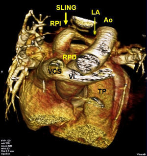 TC-3D: Reconstrucción 3D que permite una mejor identificación de la relación espacial entre el tronco pulmonar (TP), la rama pulmonar derecha (RPD), rama pulmonar izquierda (RPI), aorta (Ao), vena cava superior (VCS) y vena innominada (VI); así como el anillo vascular (sling) con el trayecto estenótico de la rama pulmonar izquierda. Ligamento arterioso (LA).