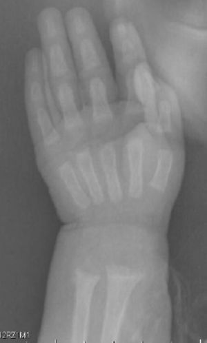 Radiografía de muñeca: metáfisis ensanchada, separada, acopada y desflecada.