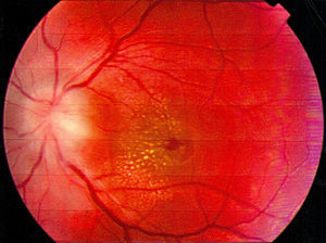 Retinografía de ojo izquierdo al ingreso: papiledema y exudado macular en forma de estrella.