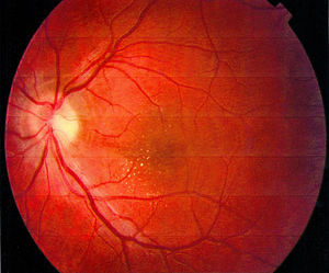 Retinografía de ojo izquierdo al alta: mejoría evolutiva.
