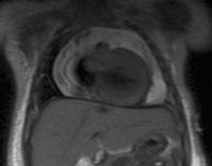 RNM en séptimo día del ingreso: Derrame pericárdico severo global y miocardiopatía hipertrófica de predominio septal.