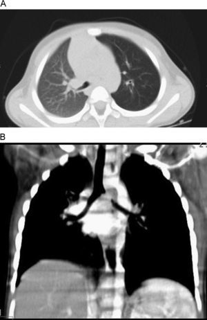 TC pulmonar de alta resolución. A) Corte transversal. B) Corte axial. Estenosis de bronquio principal izquierdo. Pulmón izquierdo hiperlucente.