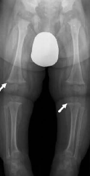 Radiografía de extremidades en lactante de 7 meses con hipocalcemia secundaria a raquitismo carencial. Las flechas marcan el ensanchamiento metafisário de fémur y tibia.