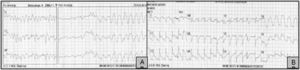 Electrocardiogramas de la paciente: A) Fibrilación ventricular. B) Ritmo sinusal (FC: 150lpm), con imagen de lesión subepicárdica anterolateral y bloqueo incompleto de rama derecha.