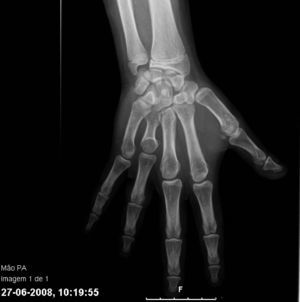 Rx de mano del paciente: braquimetacarpia en cuarto dedo y adelanto de la edad ósea.